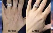 結婚指輪のために手の整形手術をする女性が増加